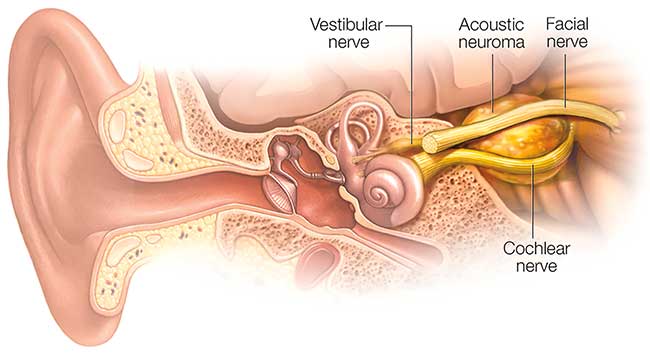 As a typical acoustic neuroma enlarges, it puts pressure on both the facial and cochlear nerves.