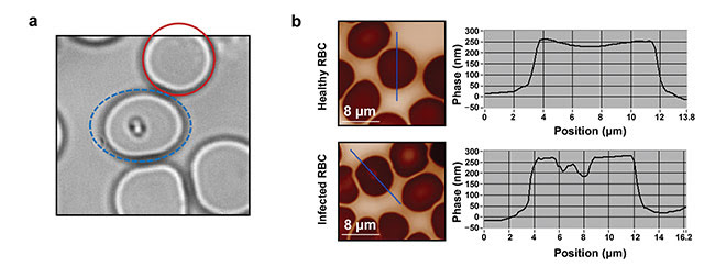 Figure 3. Parasite characterization. The red solid circle indicates a healthy blood cell; the blue dashed ellipse indicates an infected blood cell (a). QPI raw images (b, left) with their corresponding phase profiles (b, right). Courtesy of J. Klossa/TRIBVN and M. Manfait/MéDIAN Unit, UMR CNRS 6142, France.