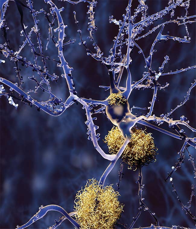 FTIR spectroscopy is bringing scientists deeper inside biological samples such as neurons (shown here invaded by amyloid plaques), allowing more extensive research of diseases such as Alzheimer’s.