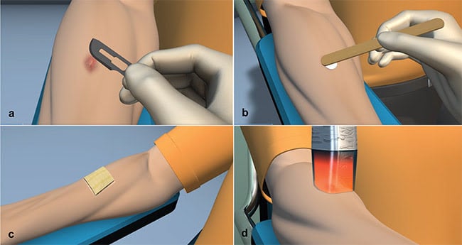 Figure 2. Sequence of photodynamic therapy (PDT) protocol for basal cell carcinoma (BCC): superficial curettage using a scalpel blade and cleansing of the lesion with a transparent cleaning solution (a); topical application of 20 percent methyl-aminolevulinate (MAL) cream over the lesion, including a 2-mm margin of normal skin (b); curative avoiding of light exposure for three hours (c); and lesion irradiation at 630 nm (d). These clinical protocols are repeated one week later. Courtesy of Cristina Kurachi.