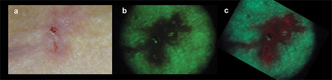 Figure 4. Clinical appearance of a basal cell carcinoma (BCC) under white light illumination (a). Wide-field fluorescence imaging under 400-nm excitation, showing the loss of autofluorescence at the lesion when compared to the surrounding normal skin (b), and the characteristic red PpIX fluorescence after three hours of incubation of 20 percent methyl-aminolevulinate (MAL) cream (c). Courtesy of Dr. Ana Gabriela Salvio/Amaral Carvalho Hospital.