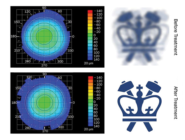 Figure 1. Columbia University’s Sinisa Vukelic deployed a pulse from a femtosecond oscillator to strengthen corneal proteins. Corneal topography before (top) and after treatment (bottom), paired with virtual vision that simulates the effects of induced refractive power change.