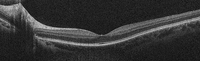 An ultrafast SD-OCT image of human retina provides both wide-field and high-resolution images. 