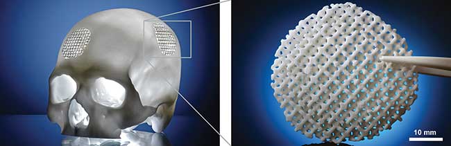 A biodegradable patient-specific cranial implant demonstrator was made by laser sintering from polylactide/calcium carbonate composite powder on the customized Formiga P 110 machine.