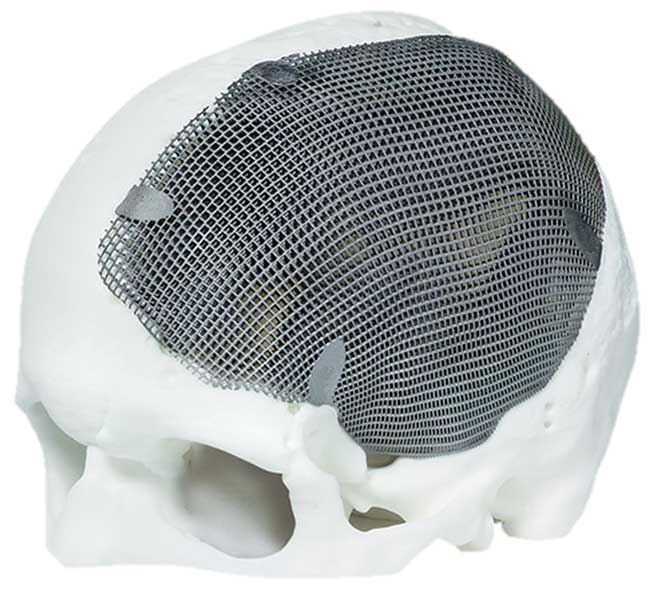 Patient-specific titanium implant made by laser sintering.