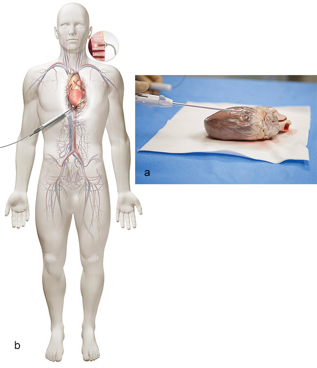 A model of the heart, with the placement of a laser-beam-bearing probe showing where channels will be cut into heart muscle to alleviate heart pain (a). The diagram shows how the procedure is carried out, with an insert indicating treatment (b). Courtesy of CryoLife Inc.