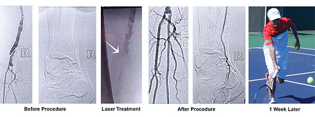 Laser treatment of occluded popliteal (back of the knee) artery improved function quickly and significantly in a 67-year-old patient. Courtesy of Ra Medical Systems Inc.