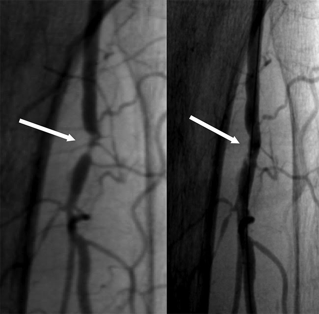 Obstruction of the popliteal artery below the knee (left). Improvement in obstruction after laser atherectomy (right). Courtesy of Dr. Eduardo Hernandez/Texas Heart Institute.