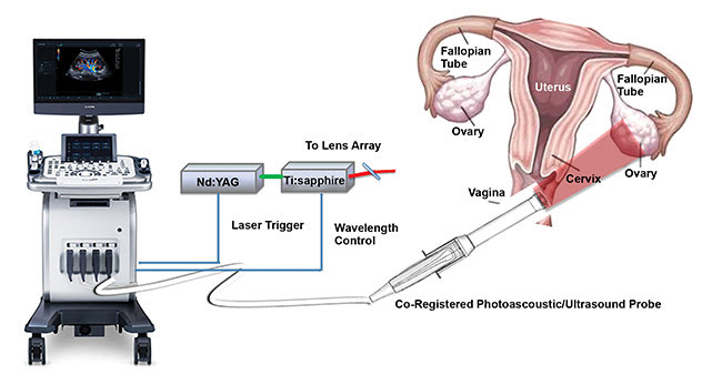 Figure 2. The co-registered photoacoustic/ultrasound system, developed by Washington University in St. Louis, and a diagram of the female reproductive system. Courtesy of Quing Zhu/Shutterstock.