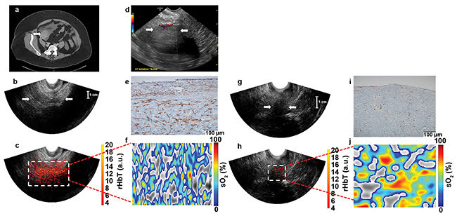 Figure 3. Contrast-enhanced CT chest/abdomen/pelvis examination of a 63-year-old postmenopausal patient with a solid right adnexal mass measuring up to 4.5 cm, ascites, and a thickened endometrium (not shown). Pathologic findings on a 5-cm ovary with well-differentiated stage 2 endometrioid adenocarcinoma and an incidental 2.2-cm benign steroid cell tumor (a). Ultrasound Doppler of the right adnexa from GE LOGIQ S8 shows a hypoechoic soft tissue mass with minimal peripheral flow on color Doppler images (b). Ultrasound image of the right adnexa obtained from the Alpinion system (c), and the co-registered ultrasound and photoacoustic imaging rHbT map shown in color (d), with extensive diffused vascular distribution covering a large area of the region of interest (ROI) in the depth range of 1 to 4 cm. The rHbT measured in the ROI was 14.58 (a.u.). CD31 immunostain in the suture area, showing numerous and extensive micro-vessels (e). sO2 map of the ROI marked by the white rectangular box in d with mean sO2 of 43.2 percent (f). Ultrasound image of the left ovary of the same patient (g). Co-registered ultrasound and photoacoustic imaging rHbT map showing scattered photoacoustic imaging signals (h); the rHbT is much lower and measured 7.73 (a.u.). CD31 immunostaining of surgical sample (i). sO2 map of the ROI identified by co-registered ultrasound with measured mean sO2 of 58.2 percent (j). Pathology found a normal ovary with no significant histopathologic abnormalities (see reference 6). Courtesy of Washington University in St. Louis.