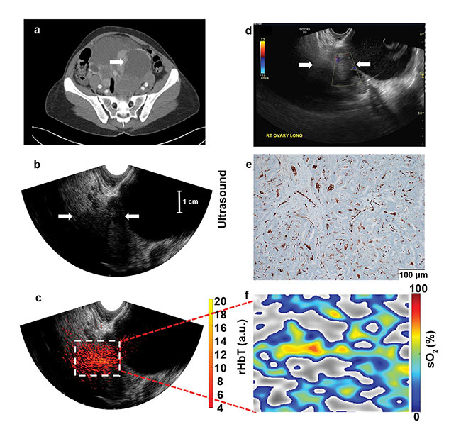 Figure 4. Images from a 50-year-old premenopausal woman with bilateral multicystic adnexal masses with septations and mural nodularity, revealed by contrast-enhanced CT; the arrow points to a 3.6-cm right adnexal mural nodule as a solid mass (a). An ultrasound Doppler image obtained by the GE LOGIQ S8 shows minimal blood flow in the solid area (b). Ultrasound image of the right adnexa (c). The co-registered ultrasound and photoacoustic imaging rHbT map shown in color, with extensive diffused vascular distribution inside the ROI in the depth range of 1.5 to 4.5 cm, next to large cystic areas identified by ultrasound (d). A CD31 immunostain of the sutured area (e). The sO2 map of the ROI, marked by the white rectangular box in d; pathology showed well-differentiated stage 1 endometrioid adenocarcinomas of both the right and left ovaries, which measured 8.3 cm and 20 cm, respectively; the rHbT measured in the ROI was 12.18 (a.u.), and the mean sO2 was 50.1 percent (see reference 6). Courtesy of Washington University in St. Louis.