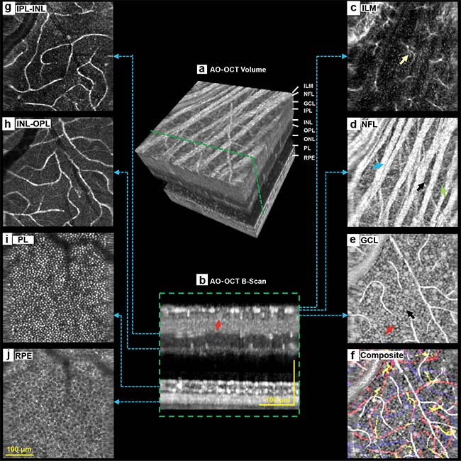 Figure 4. Detailed 3D imaging of retinal cellular structures using a multimodal AO-OCT system utilizing a Wasatch Photonics Cobra-S 800-nm spectrometer. AO-OCT volume of the retina (a), a single AO-OCT B-scan (b), starlike microglial cells speckling the inner limiting membrane (c), nerve fiber layer showing nerve fiber bundles (d), ganglion cell layer showing a mosaic of somas (e), a composite image overlaying multiple colorized layer images (f), capillaries spanning the IPL-INL and INL-OPL boundaries (g, h), photoreceptor layer (i), retinal pigment epithelium (j). Courtesy of Zhuolin Liu and Daniel X. Hammer.