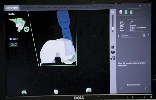 Stryker’s combination of preoperative and intraoperative imaging enables precise cutting to ensure reduced recovery time and an optimal fit for joint replacements. Here, the saw is nearly finished with the cutting plan, displayed in green toward the bottom of the 3D model on the monitor. Courtesy of Stryker. 