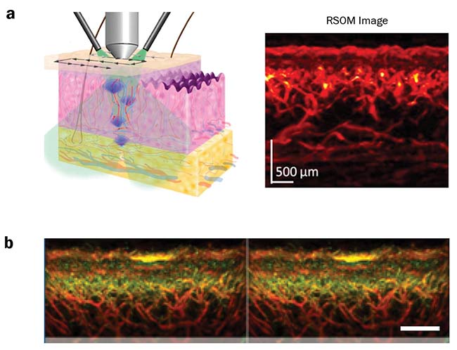 Figure 3. A raster-scanning optoacoustic mesoscopy (RSOM) scan of skin with the resulting image (a). The different layers of the skin can be clearly distinguished. Benign nevus on human forearm, shown in yellow; smaller vessels are shown in green and bigger vessels in red (b). Courtesy of iTheraMedical.