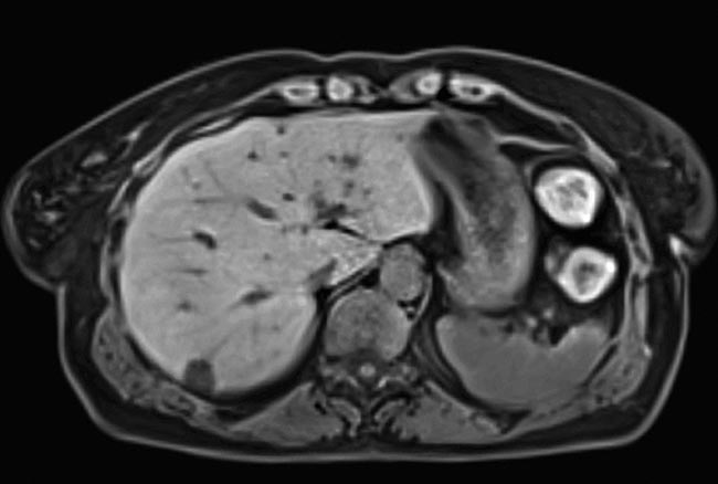 An image of the liver of a free-breathing patient, taken with compressed sensing. Data acquisition accelerated as much as 40-fold. Courtesy of Siemens Healthineers. 