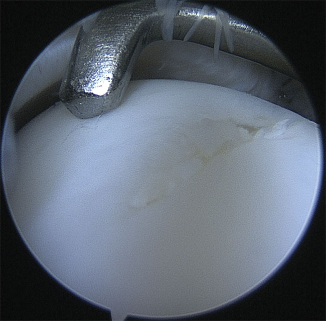 Figure 1. Visual evaluation of articular cartilage with a conventional arthroscope (camera), along with the assessment of the tissue’s functional integrity by palpation with a metallic hook. Courtesy of the Department of Equine Sciences/Utrecht University.