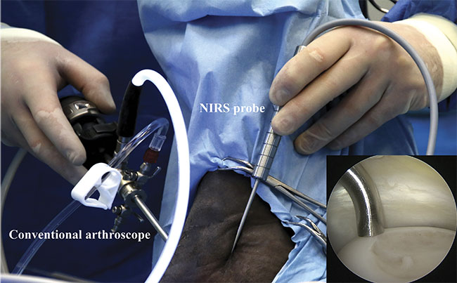 Arthroscopic NIRS measurements in the equine joint in vivo. The NIRS probe is aligned perpendicular to articular cartilage by monitoring with an arthroscope (camera). NIRS-probe alignment on cartilage surface (inset). Courtesy of Biophysics of Bone and Cartilage/University of Eastern Finland.