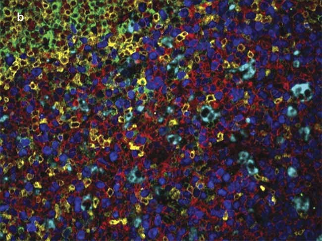 Human tonsil stained with DAPI (4',6-diamidino-2-phenylindole) and five spectrally distinct quantum- dot-labeled primary antibodies against Ki67 (pseudocolored blue), CD3 (yellow), CD20 (red), IgD-positive (green), and CD68 (cyan) (a). The stained specimen was imaged with a Nuance multispectral camera and individual channels were unmixed with optimized spectral endmembers (b). The cortex and mantle zone (upper left corner, b) is visualized and indicated by the yellow and green cells, respectively. Sample courtesy of Dr. Stefania Pittaluga/National Cancer Institute. Spectral analysis courtesy of Dr. Richard Levenson/UC Davis Health.