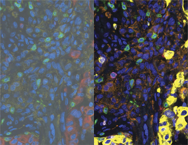 Multiplex immunofluorescence for evaluation of the tumor immune microenvironment (TIME). Seven-color TSA (tyramide signal amplification) staining of breast cancer showing the original multispectral ‘mixed’ image (left) and the unmixed pseudocolor image (right) generated using Vectra 3.0 multispectral microscope and inForm analysis. Pseudocolor key (right): blue: DNA; yellow: keratin; green: CD3; orange: CD68; white: PD1; red: PDL1; magenta: CD8. Courtesy of Hidetoshi Mori/Borowsky Lab/UC Davis and the Center for Genomic Pathology.