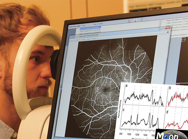 Figure 3. The use of various technologies to identify neurodegeneration through examination of the eyes is the charge of the MOON project in Europe. Courtesy of the MOON consortium.