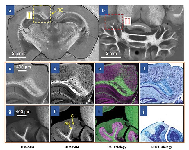 Imaging of mouse brain slices using mid-infrared photoacoustic microscopy (MIR-PAM). MIR-PAM images of myelin in 300-µm-thick slices of the cerebrum (a) and the cerebellum (b). Close-up MIR-PAM image of myelin (c). Ultraviolet-localized MIR photoacoustic microscopy (ULM-PAM) image of myelin (d). Photoacoustic (PA)-histologic image (e). Luxol fast blue (LFB)-stained histologic image (f) of the same area (I) shown in the cerebrum image (a). Close-up MIR-PAM image of myelin (g). ULM-PAM image of myelin (h). PA-histologic image (i). LFB-stained histologic image (j) of the same area (II) shown in the cerebellum image (b). In the PA-histologic images, green represents myelin and violet represents nucleic acids. In the LFB-stained histologic images, blue represents myelin and deep blue represents nucleic acids. RC: retrosplenial cortex; AB: arbor vitae region; G: granular region. Courtesy of Lihong Wang.