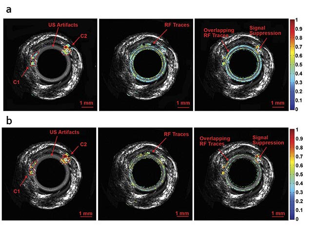 Normalized intravascular ultrasound (IVUS) image of the swine atherosclerotic artery phantom (a). Normalized amplitude images (b) and normalized phase images of IV-differential photoacoustic radar (DPAR), 980-nm IV-PAR, and 1210-nm IV-PAR modes (c). The same 14-MHz endoscopic transducer was shared by IVUS and IV-(D)PAR systems for co-registration. C1: artificial cholesterol 1; C2: artificial cholesterol 2; RF: radio frequency. Courtesy of Andreas Mandelis.