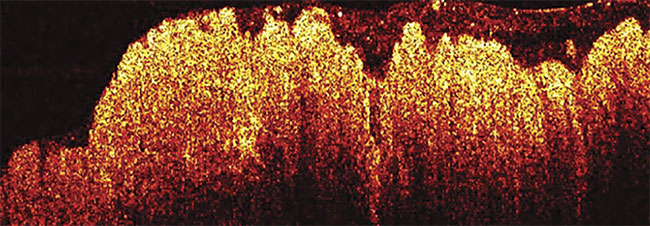 OCT Informs Real-Time Cancer Diagnosis