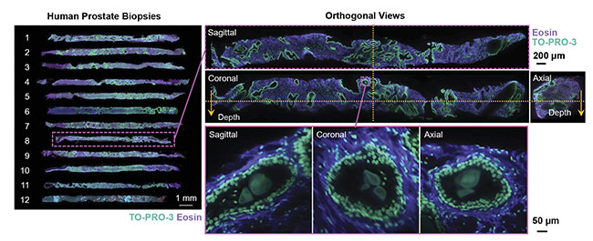 Figure 2. 3D images of human prostate biopsies demonstrating the type of cellular information available from 3D sample analysis that is not available from standard 2D histology slides. Courtesy of A. Glaser/University of Washington Molecular Biophotonics Laboratory.