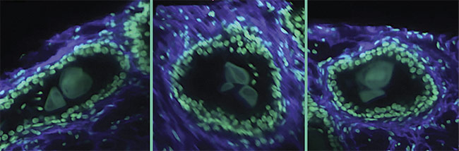 A 3D image of a human prostate biopsy. Courtesy of A. Glaser/University of Washington Molecular Biophotonics Laboratory.
