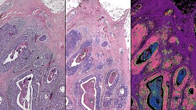 This side-by-side comparison of a breast tissue biopsy demonstrates some of the infrared-optical hybrid microscope’s capabilities. On the left, a tissue sample dyed by traditional methods. Center, a computed stain created from infrared-optical hybrid imaging. Right, tissue types identified with infrared data. The pink in this image signifies malignant cancer. Courtesy of Rohit Bhargava, University of Illinois.
