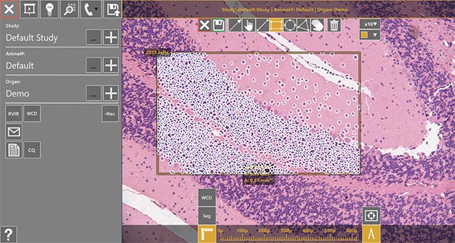  Figure 3. A screenshot of quantitative image analysis software deployed in real time within the microscope. The pathologist chooses an area and then uses computer-assisted diagnostic toolsets. The AR enables the pathologist to view results in the microscope as well. Courtesy of Augmentiqs. 