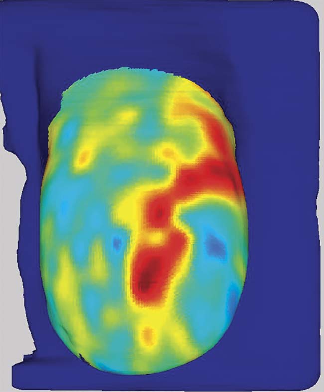 Figure 3. A DOS image of oxyhemoglobin concentration in a healthy breast. Courtesy of Thomas O’Sullivan.
