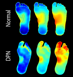 VisionQuest Fig 1: The recovery patterns of a foot with (bottom) and without diabetic peripheral neuropathy, shown in an infrared image. Courtesy of VisionQuest.