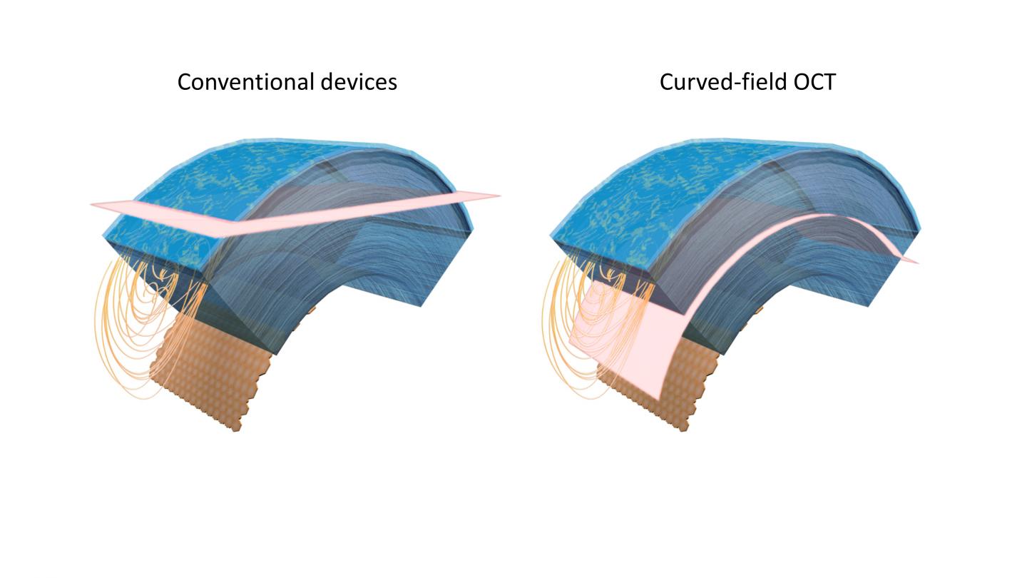raditional imaging approaches acquire a flat slice (pink) that crosses through several corneal layers at once, limiting the field of view (left). The new curved-field OCT approach matches the curvature of the cornea to provide a larger imaging area (right). Courtesy of Viacheslav Mazlin, The Langevin Institute.