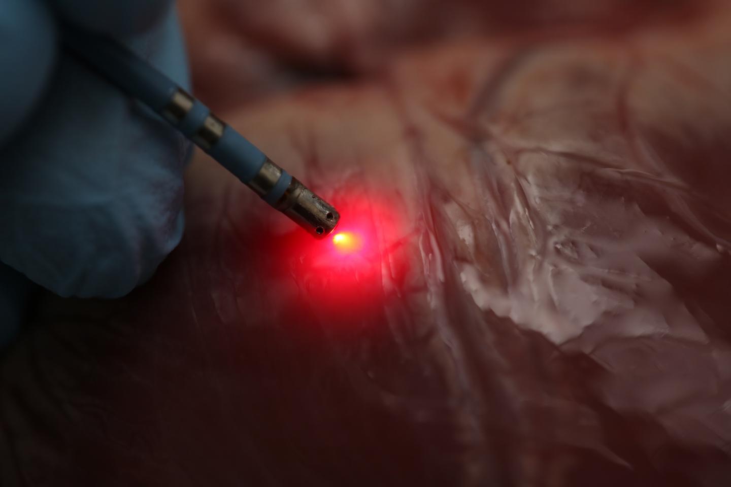 A new ablation catheter incorporating near-infrared spectroscopy mapping can successfully distinguish various tissue types in hearts. This distinction is critical when using radiofrequency ablation to treat heart rhythm problems. Courtesy of Christine P. Hendon, Columbia University and John Abbott.