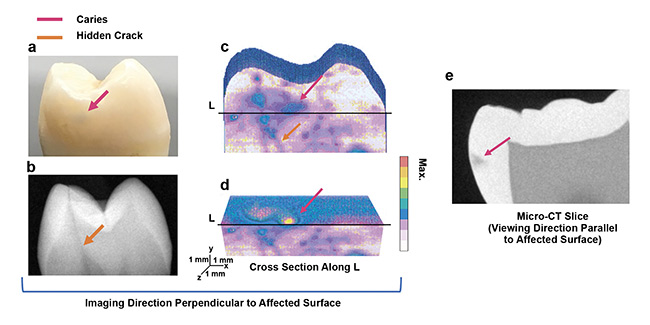 Figure 3. Application of eTC-PCT to early caries. Interrogated mesial surface of dental sample and its x-ray image. Color arrows point to initial caries (not visible in x-ray), enamel, and hidden crack (visible in x-ray) (a, b). eTC-PCT reconstructed 3D image of the mesial surface showing the caries and the crack (c). A transverse cross section of this reconstruction, cut along line L, as marked. Caries are seen extending inside the tooth over the cross section (d). Sagittal micro-CT slice image, showing the location and extent of the caries behind the mesial surface (e). Courtesy of University of Toronto.