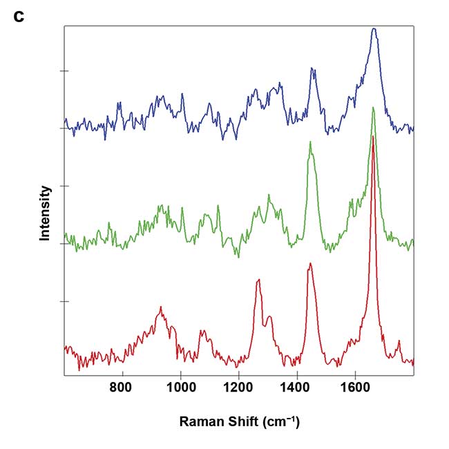 Figure 2. Raman imaging of human endothelial cells visualizes increased intracellular lipid storage (red) after treatment when comparing untreated control cells (a) to progesterone-treated cells (b). Images were color-coded according to the spectral components. Nucleus: blue; cytoplasm: green; lipids: red (c). Courtesy of AG Schenke-Layland/University of Tübingen.