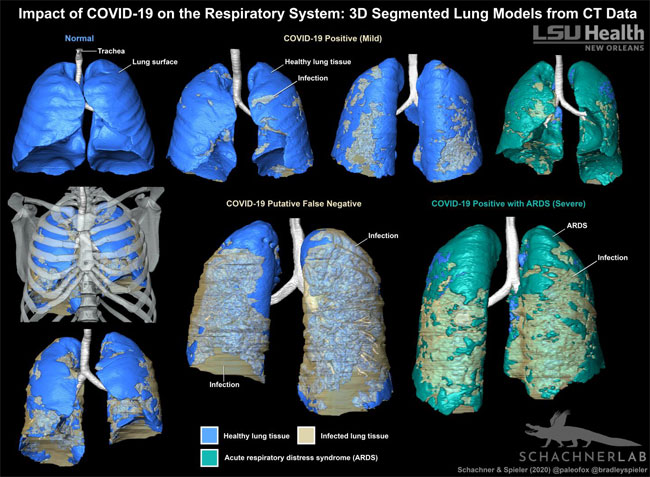 3D Imaging Tool Can Aid in COVID-19 Diagnoses