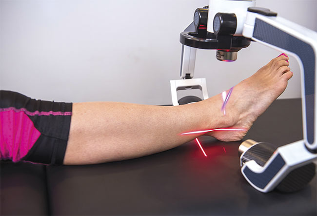 In addition to recently receiving FDA 510(k) clearance for treating pain indication using a violet laser, Erchonia is exploring using green light for pain and is sponsoring an active clinical trial using its 635-nm red laser device on diabetic peripheral neuropathy pain. Courtesy of Erchonia.