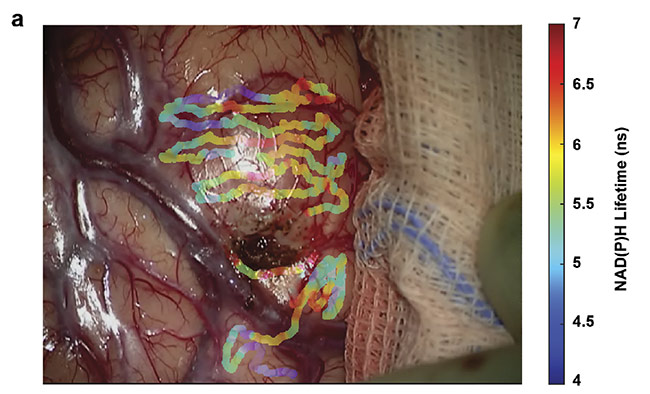 Figure 3. Overlays of nicotinamide adenine dinucleotide (NAD(P)H) lifetimes on a tumor-infiltrated cortical surface (a) and a visibly clear cortex (b) of a glioblastoma patient. Courtesy of University of California, Davis.