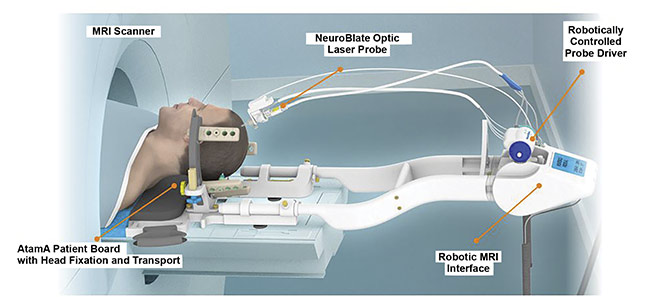 Figure 3. An illustration of the placement of a patient in an MRI scanner while the NeuroBlate system is used for treatment. Courtesy of Monteris.