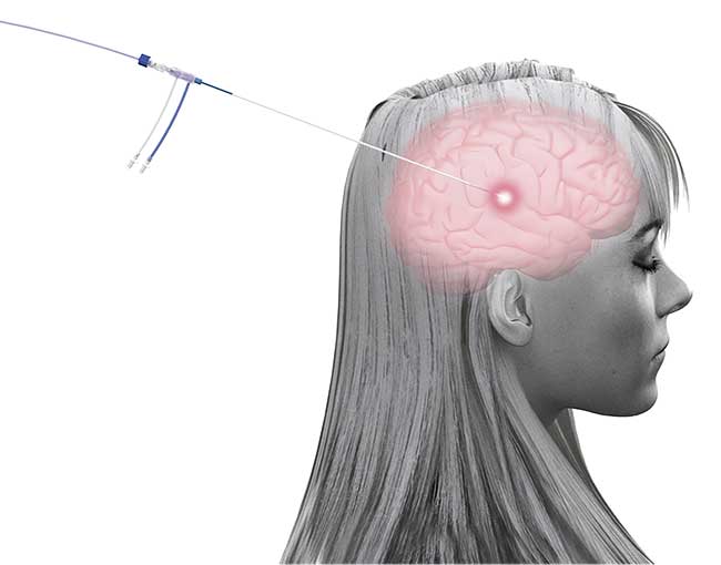 An illustration of the Visualase system connected to a patient’s brain. Courtesy of Medtronic.
