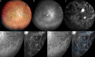 (a): Multicolor widefield SLO image of the right fundus of a 65-year-old man with proliferative DR showing multiple hemorrhages in a wide area of the fundus. (b): Blue SLO image showing a hyporeflective area in the mid-periphery to periphery of the fundus. (c): Widefield fluorescein angiogram image shows widespread non-perfused areas in the mid-periphery to periphery. Neovascularization is also seen in the superior pole of the eye. (d): Magnified image of image (b) shows hyporeflective areas in the lower temporal quadrant. (e): Magnified fluorescein angiogram image of image (c) shows non-perfused areas in the same quadrant of image (d). (f): The hyporeflective areas in image (d) are outlined by white dots. (g): The non-perfused areas in image (e) are outlined by blue dots. The outline of white dots in image (f) is located inside the outline of blue dots in image (g). Courtesy of the Department of Ophthalmology and Visual Science, TMDU.