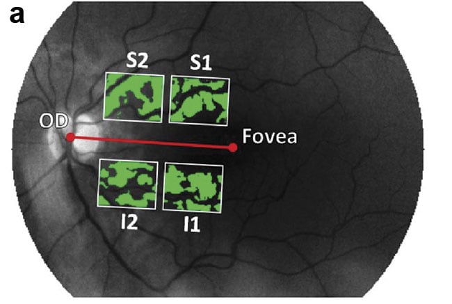 Figure 5. Four regions of interest are defined — superior 1 (S1), superior 2 (S2), inferior 1 (I1), and inferior 2 (I2) — relative to a line going through the center of the optic disc (OD). The areas used for the analysis (green) show the retinal blood vessels subtracted from the image (a). The mean spectra in the regions of interest (b). The mean (shaded), plus or minus the standard error of the mean. AD: Alzheimer’s disease. Courtesy of UZ Leuven.