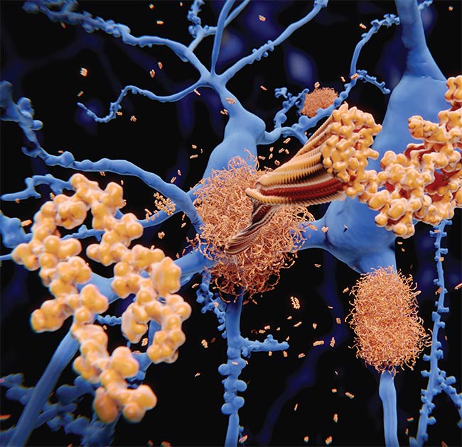 Figure 1. It is possible to detect amyloid beta protein accumulations in the brain of patients with Alzheimer’s disease, but the process can be invasive and expensive when using traditional methods. Courtesy of iStock.com/selvanegra.