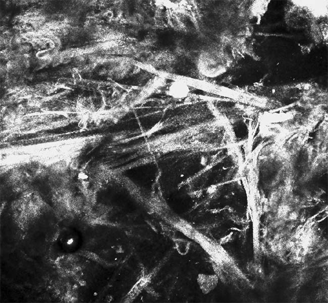 A reflectance confocal microscopy image of basal cell carcinoma prior to treatment with a carbon dioxide laser (top). A reflectance confocal microscopy image of the skin area following treatment of the carcinoma with a laser (bottom), showing that the treatment was able to identify and remove many residual cancer cells on the first pass with the laser. Courtesy of Miguel Cordova and Anthony Rossi.