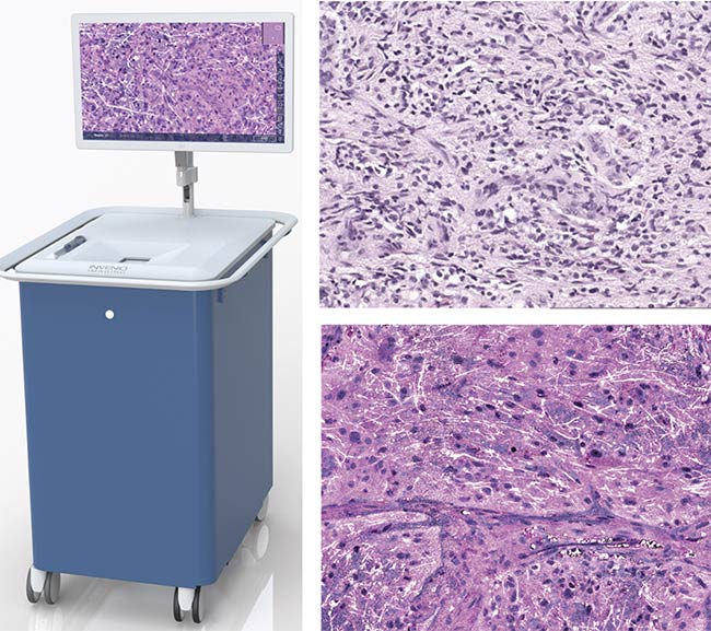 A rendering of the NIO Laser Imaging System developed by Invenio (left). An image captured with traditional H&E stain histology (top right) versus the stimulated Raman histology the system captures (bottom right). Invenio’s system leverages a dual-wavelength fiber laser based on erbium and ytterbium sources to capture 3D color images for neurosurgery without the need for sectioning or dye staining. Courtesy of Invenio.