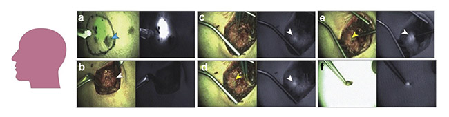 Figure 5. Composite (green signal) and adjacent fluorescence (white signal) displays of a male patient injected with Cy5.5-loaded silica nanoparticles near a scalp melanoma (a). The progressive increase in fluorescence signal corresponding to a metastatic intraparotid 1.5- to 2-cm-deep sentinel lymph node (b-e). Ex vivo sentinel lymph node (f). Adapted with permission from Reference 5/JAMA Network Open.