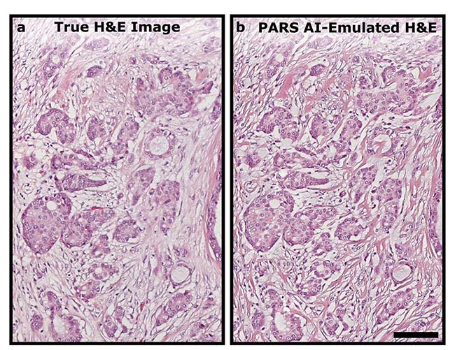 A direct one-to-one comparison between a hematoxylin and eosin (H&E)-stained slide (a) and a second-generation PARS H&E-like image (b) of the same section of human breast tissue from an unstained slide. Scale bar: 100 µm. Courtesy of PhotoMedicine Labs.