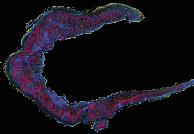 A second-generation photoacoustic remote sensing (PARS) image of a resected human skin tissue section exhibiting squamous cell carcinoma. Nuclei (red and pink). Connective tissues (blue, green, yellow). Courtesy of PhotoMedicine Labs.